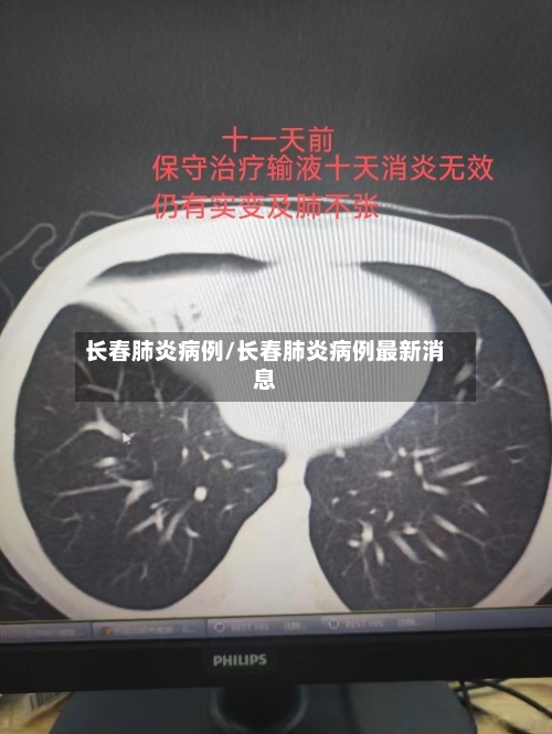 长春肺炎病例/长春肺炎病例最新消息-第2张图片